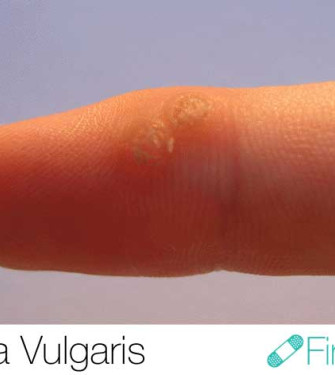 Mυρμηγκιά vulgaris: Αιτίες, συμπτώματα και θεραπευτικές επιλογές