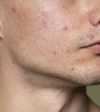Τα καλύτερα προϊόντα για άνδρες με ακνεϊκό δέρμα στο πρόσωπο και στο τριχωτό της κεφαλής