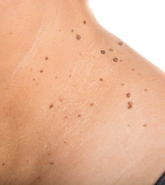 Οι ακροχορδώνες ( Skin tags ) ή δερματικά θηλώματα Αιτίες, συμπτώματα και θεραπευτικές επιλογές