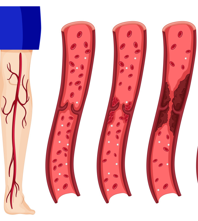 Πώς να βελτιώσετε τα σπασμένα αιμοφόρα αγγεία στα πόδια που προκαλούνται από την παρατεταμένη ορθοστασία