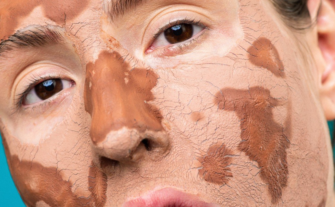 Οι κορυφαίες 6 θεραπείες για το ξηρό δέρμα στο πρόσωπο